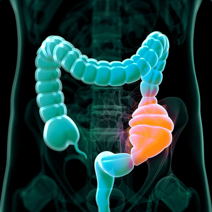 Verschil acute chronische constipatie